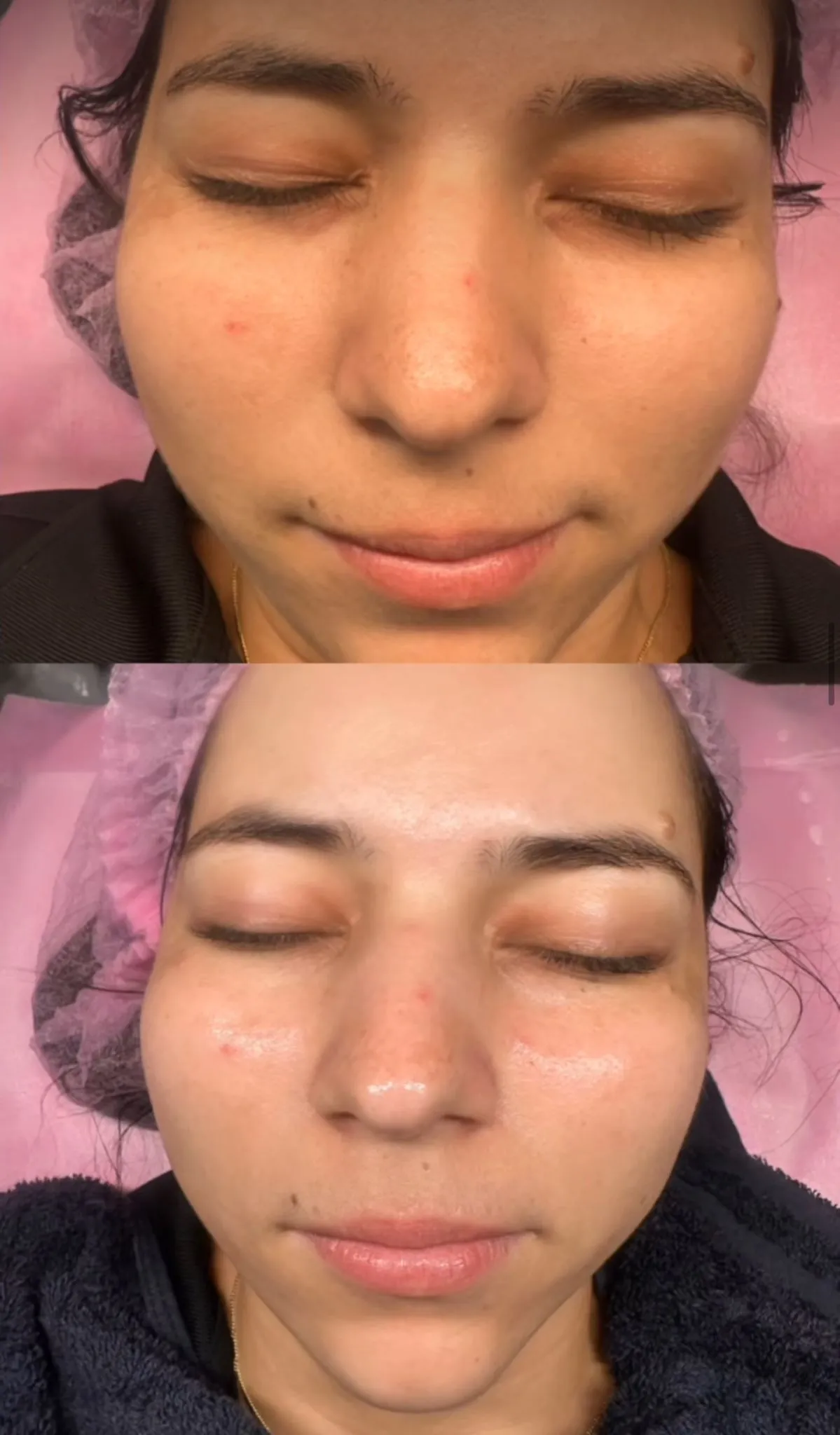 HydraFacial transformation