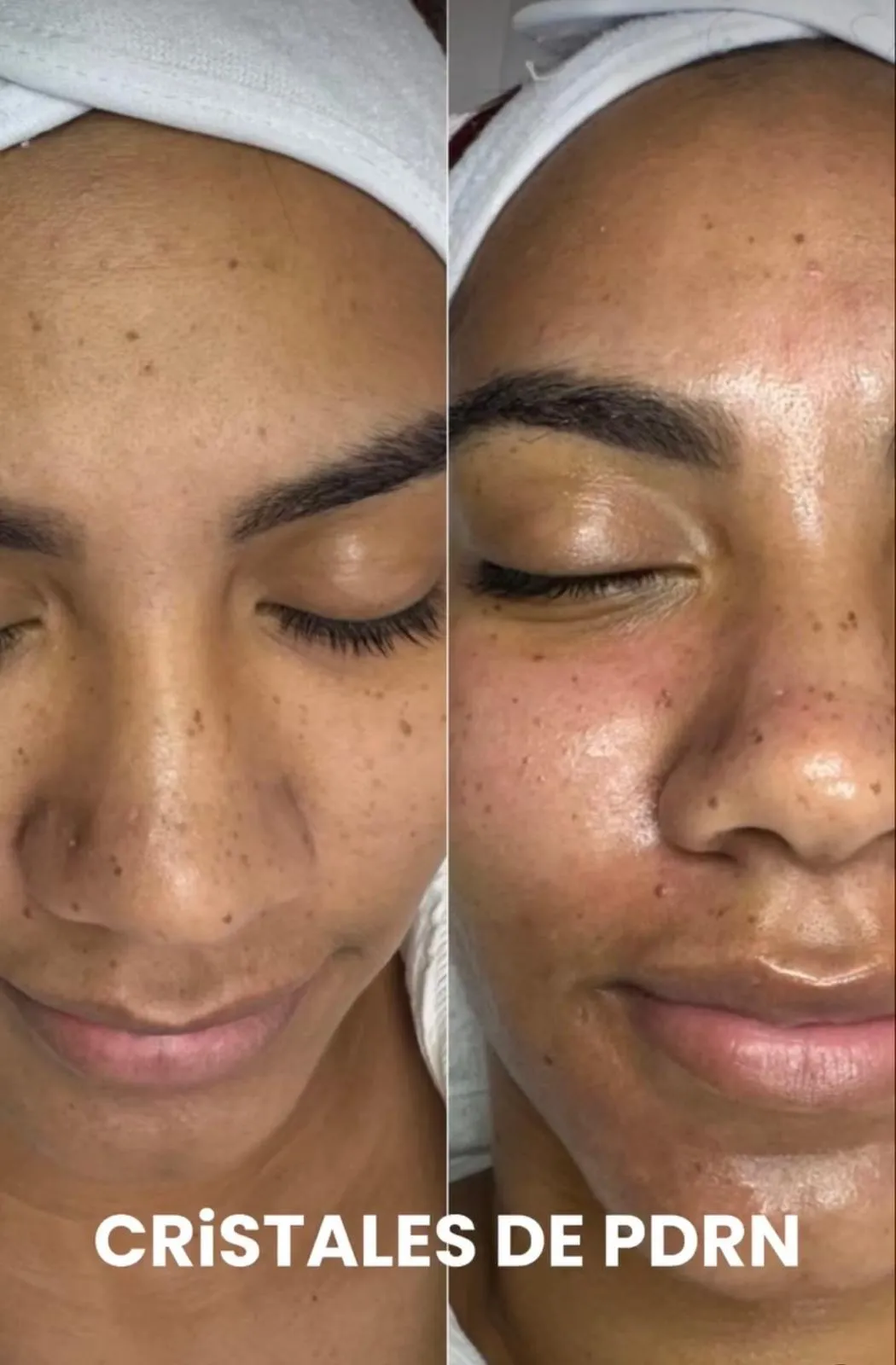 PDRN Salmon transformation