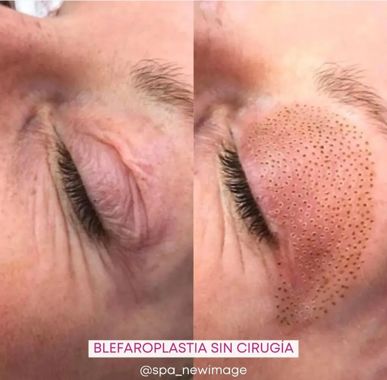 Blepharoplasty transformation