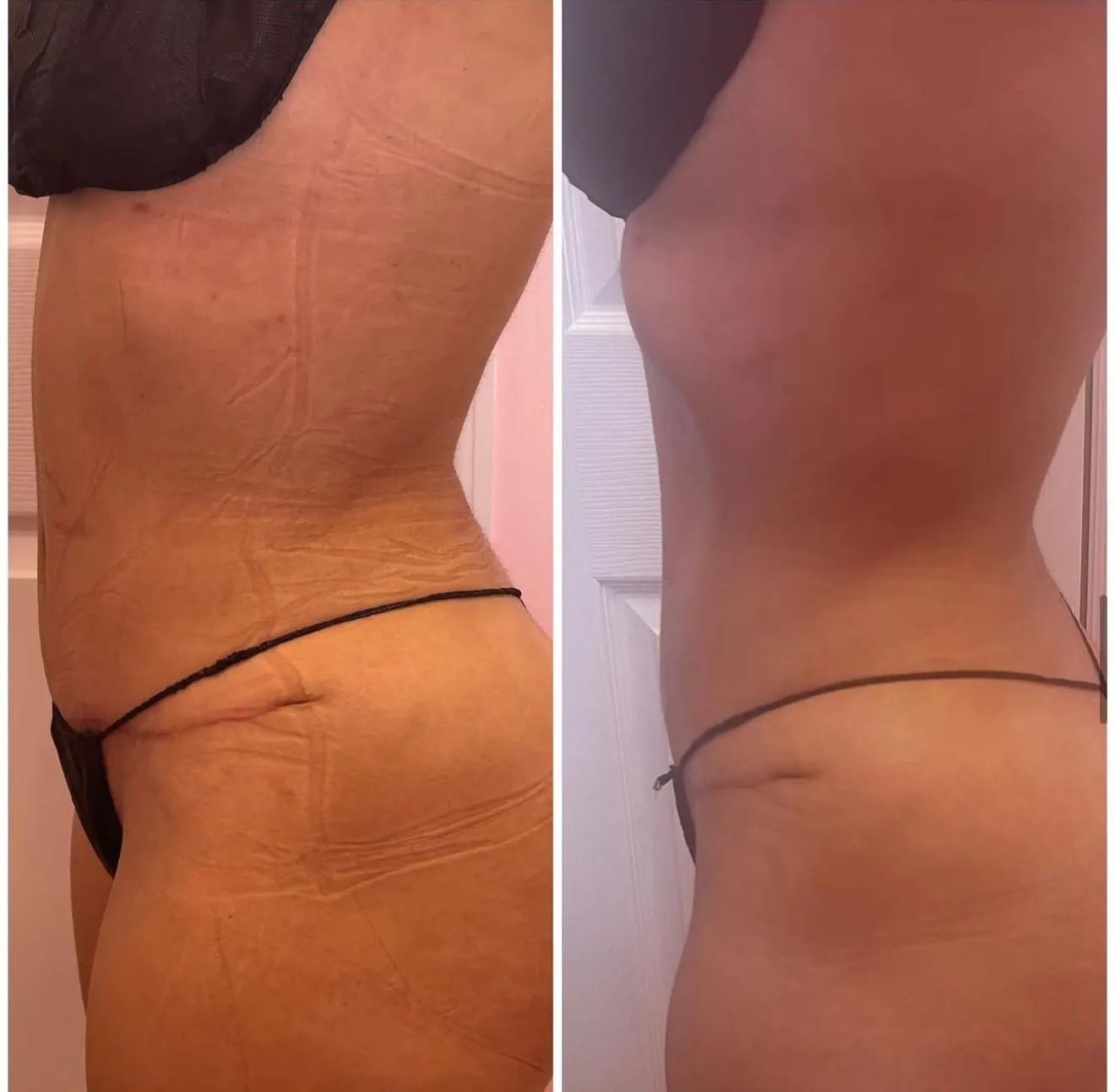 Lymphatic drainage transformation