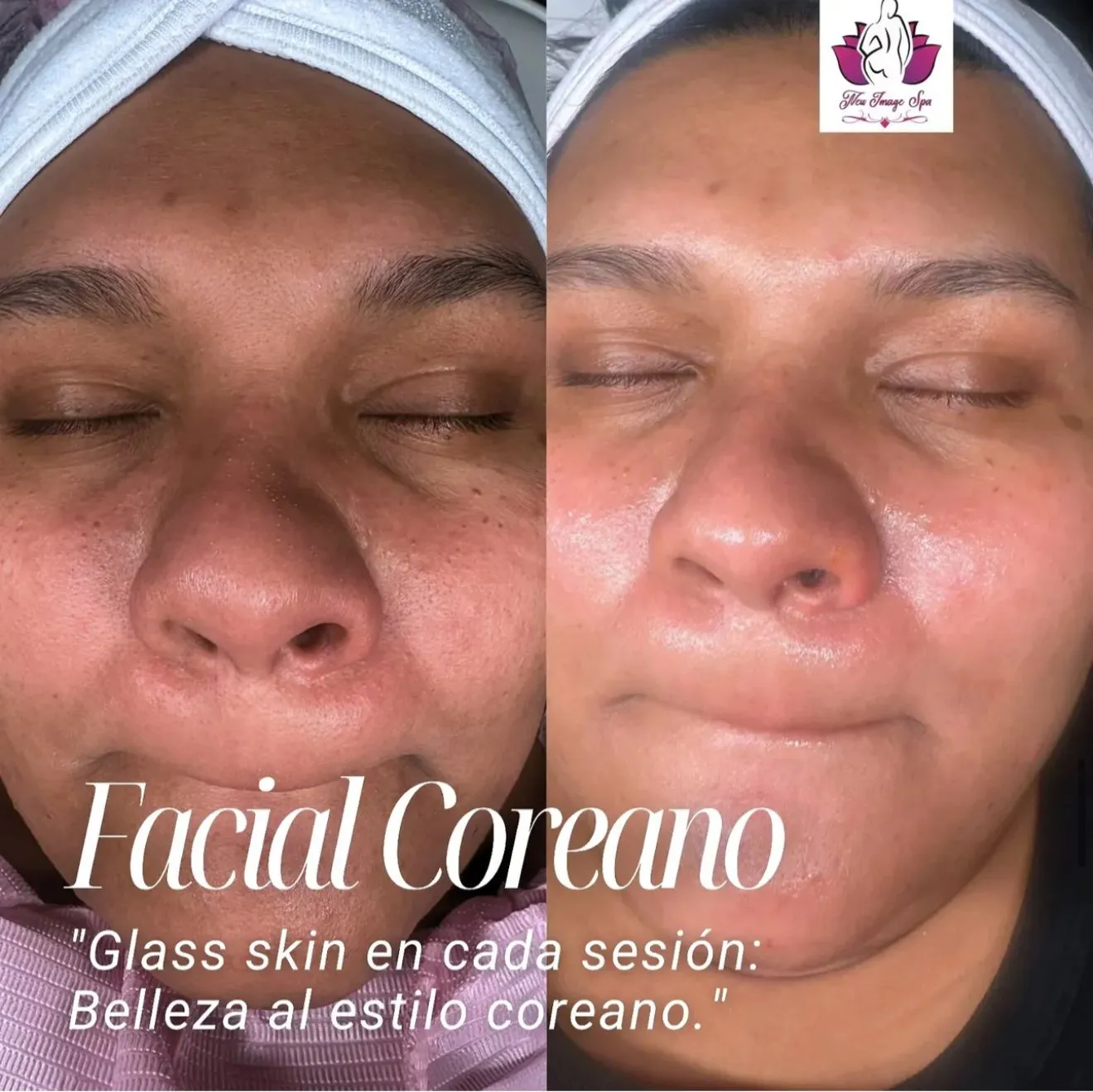 Korean facial transformation