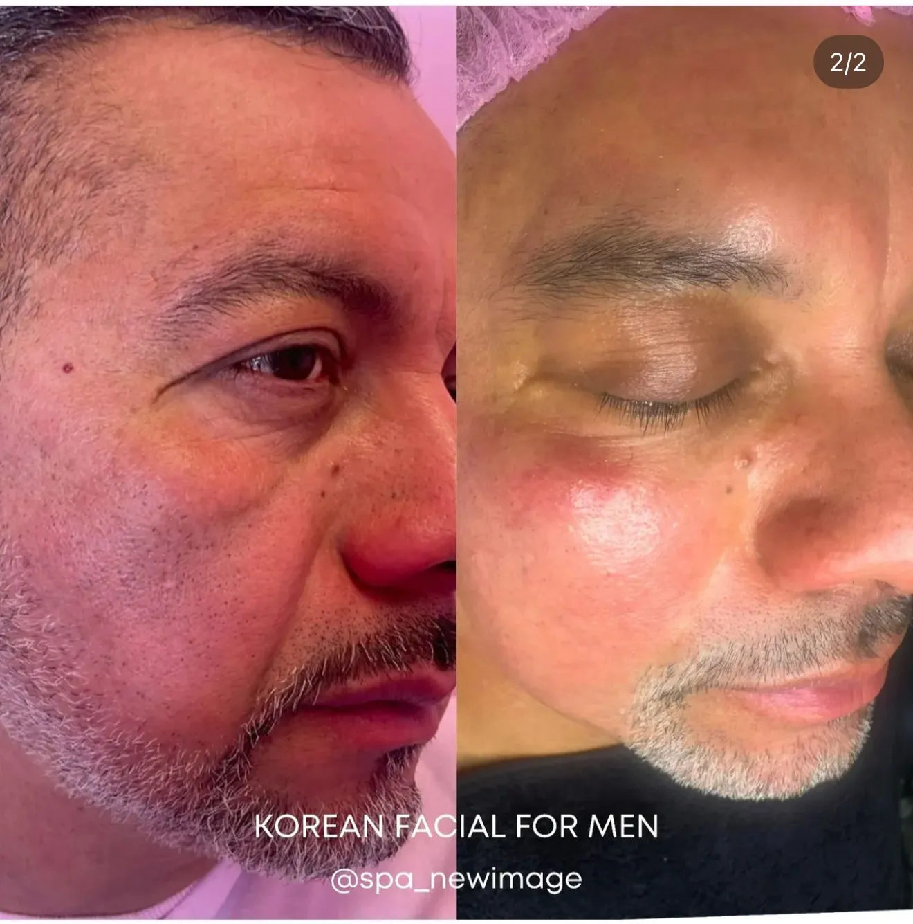Korean facial pro transformation