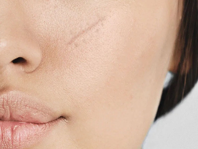 Laser Scar Treatment - New Image Spa