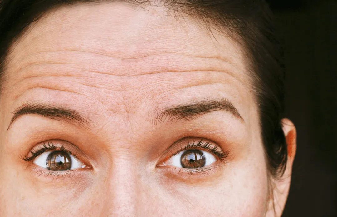 Laser Wrinkle Treatment
