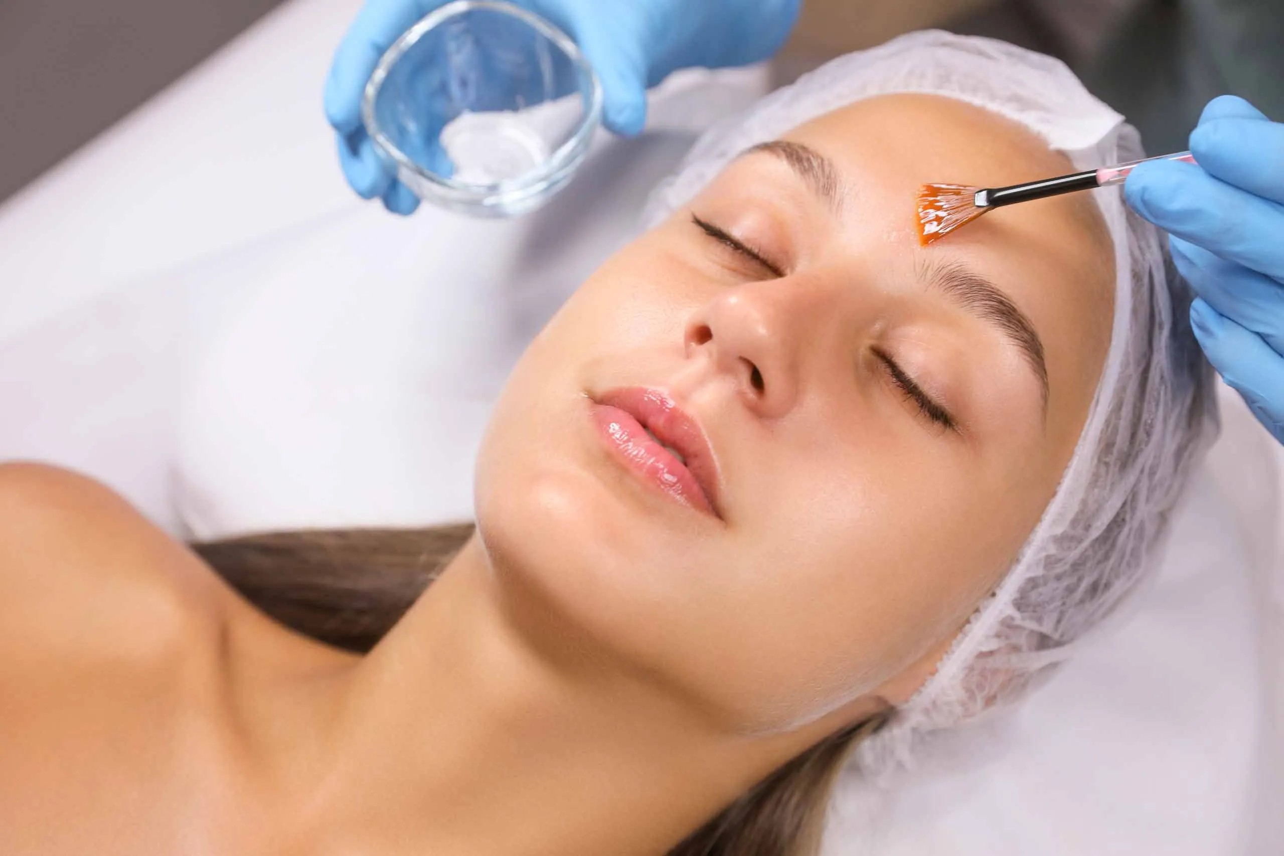 New Image Spa - Anti-Acne Chemical Peel