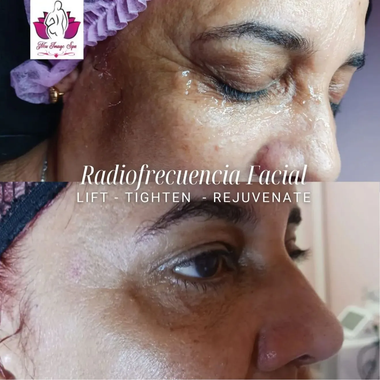 Radiofrequency facial transformation